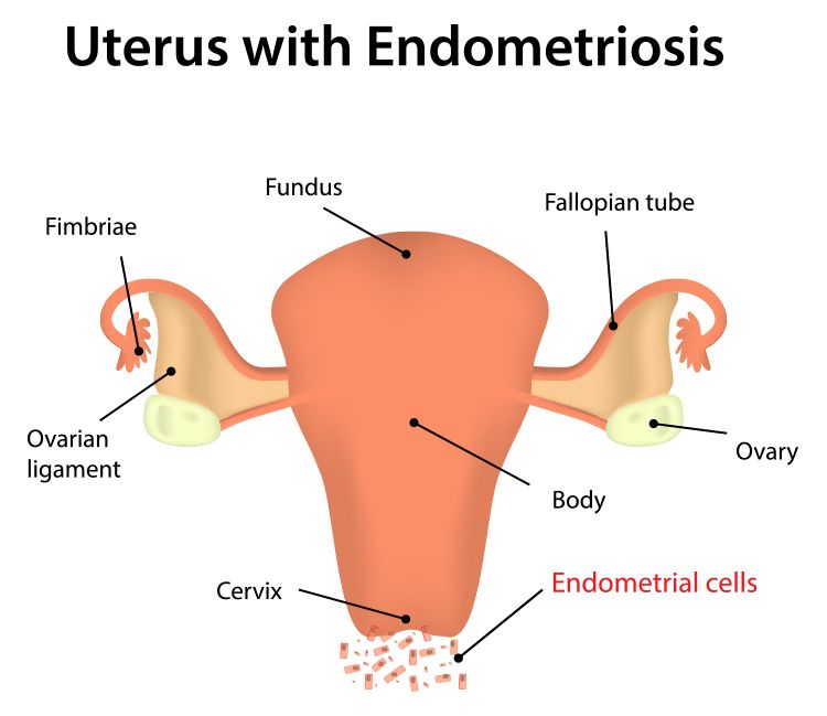 ENDOMETRIOSIS AND IVF TREATMENT